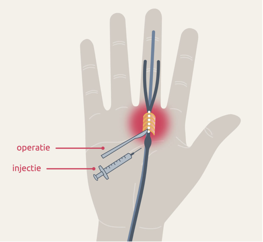 Wilt u meer weten over triggerfinger? Via onze website kunt u meer informatie vinden of neemt u eenvoudig contact met ons op.